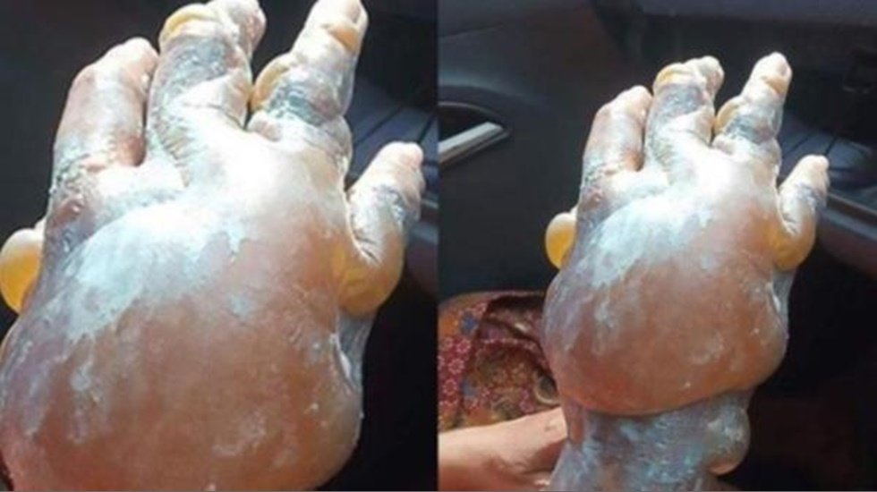 Yanığa bu maddeyi sakın sürmeyin