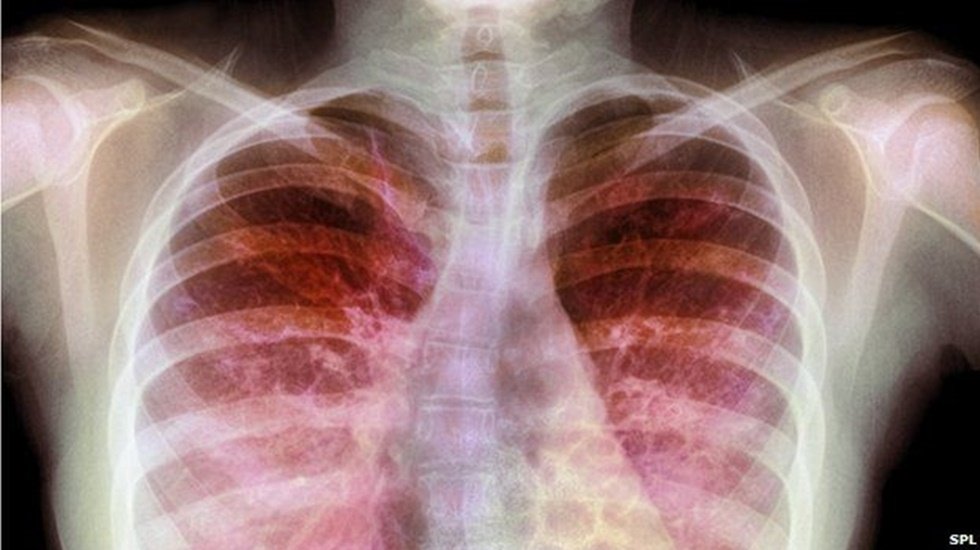 Kistik fibrozis hastalarının sorunları Meclis g&uuml;ndeminde