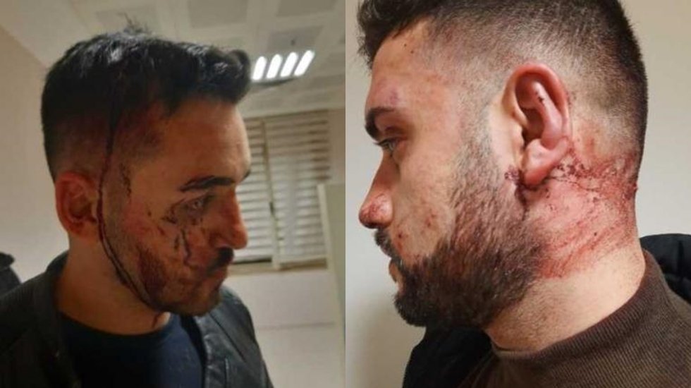 Beylikd&uuml;z&uuml;'nde gece kul&uuml;b&uuml;nde 'işkence': 'kafamda şişe kırdılar'&nbsp;