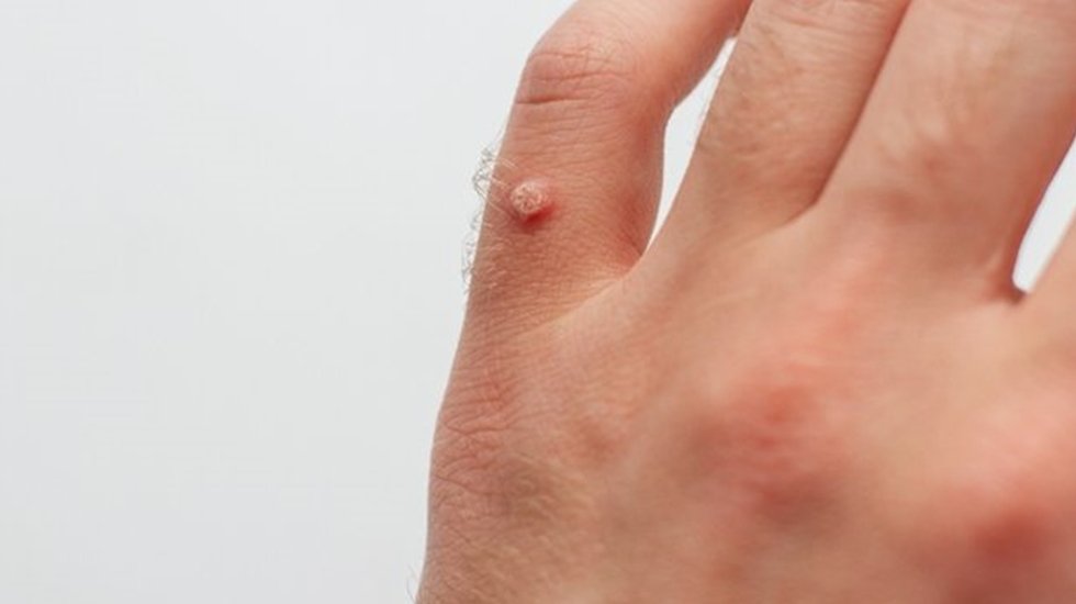 Siğili olan kişi ağda, manik&uuml;r, pedik&uuml;r yaptırmamalı