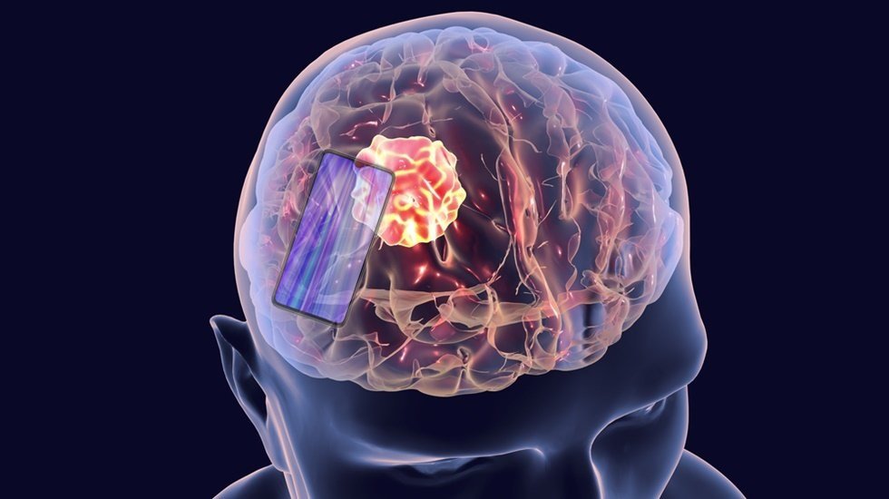 Parkinson ve titremeye karşı beyin pili tedavisi