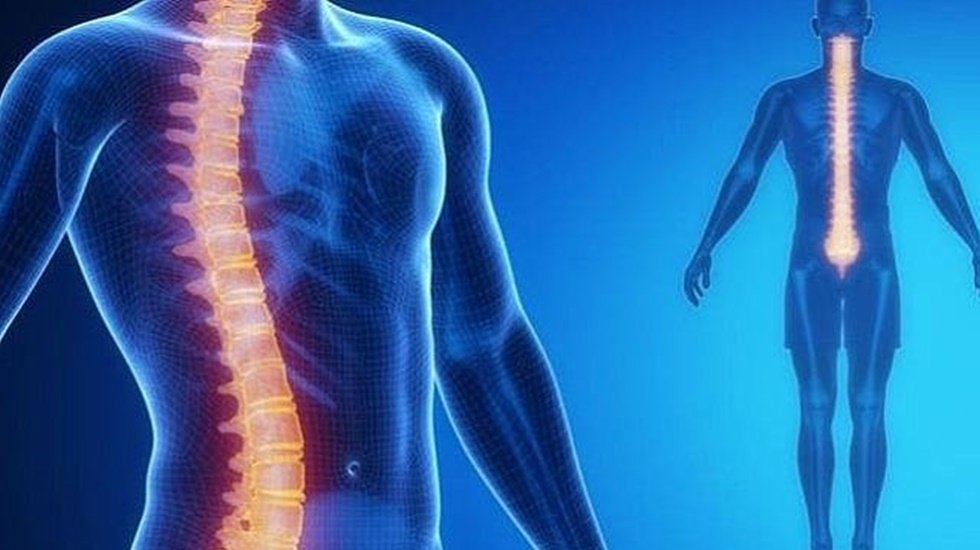 Türkiye'de en az 150.000 çocukta skolyoz olduğu tahmin ediliyor