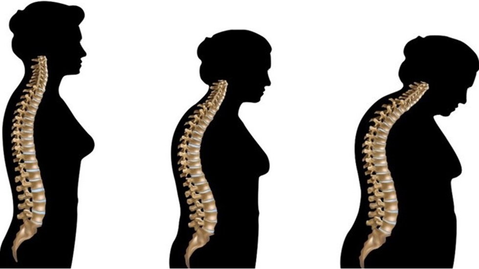 İleri yaşta yatağa bağımlılıktan korunmak için osteoporoza dikkat!