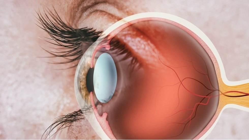 Retina yırtığında erken tedavi uyarısı