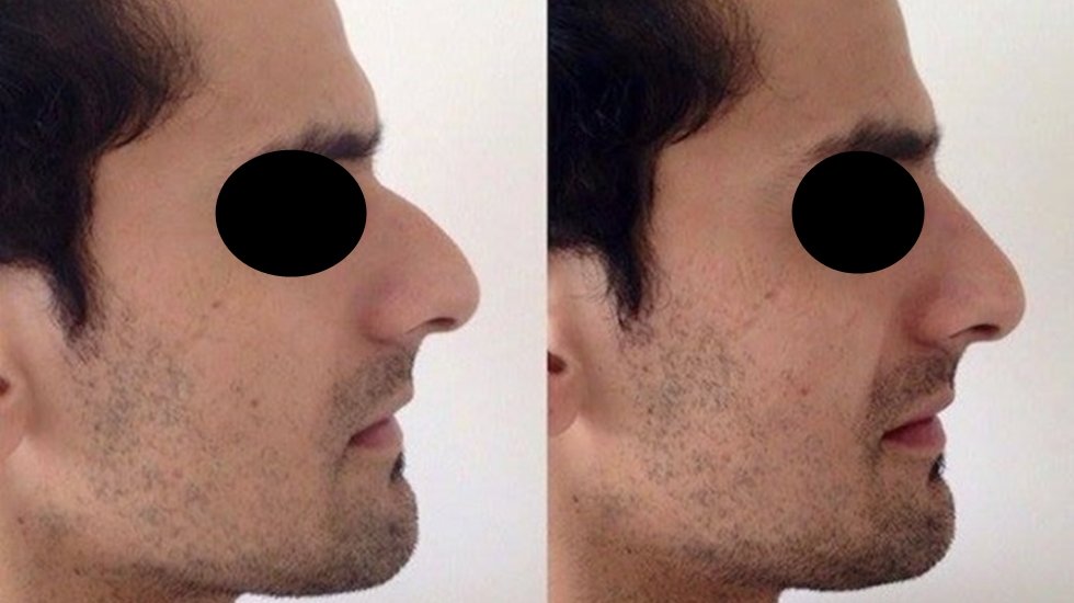 Erkeklerde burun estetiğinden sonra alınması gerekli önlemler