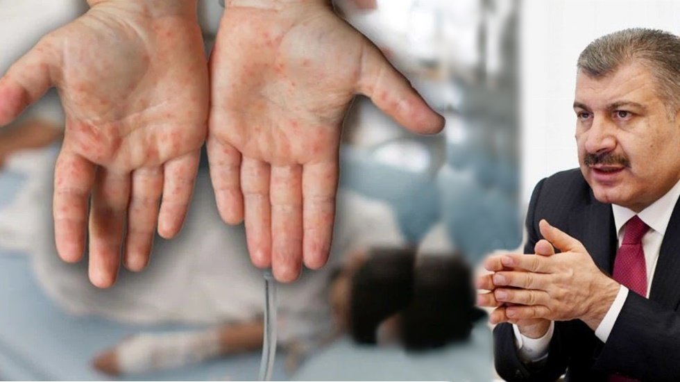 Sağlık Bakanı Fahrettin Koca, kızamık vakalarında artışı kabul etti