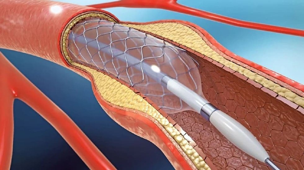 Yüzde 99 tıkalı olan şah damara el bileğinden girilerek stent takıldı