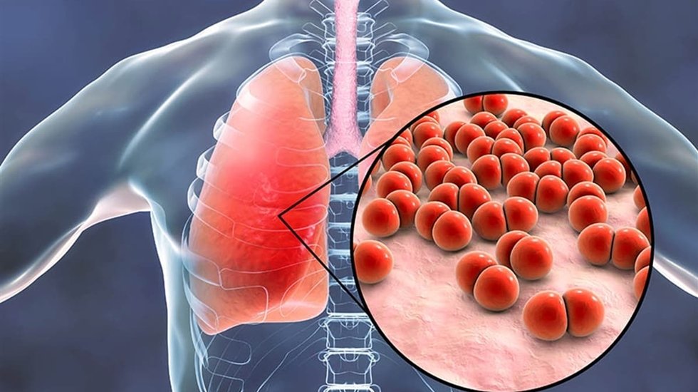 Giderek yayılan zatürre salgını Mycoplasma pneumoniae’nın henüz aşısı yok...